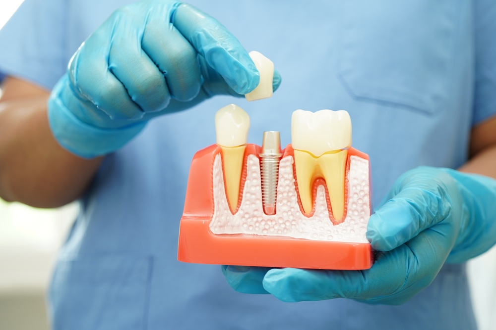 Dental Implants in Forney